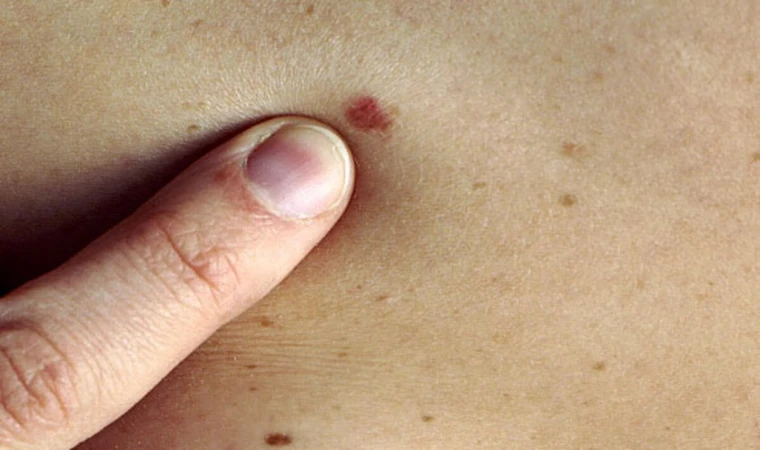 Cilt Kanserinin 6 Belirtisine Dikkat!
