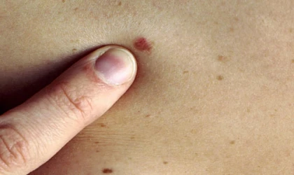 Cilt Kanserinin 6 Belirtisine Dikkat!